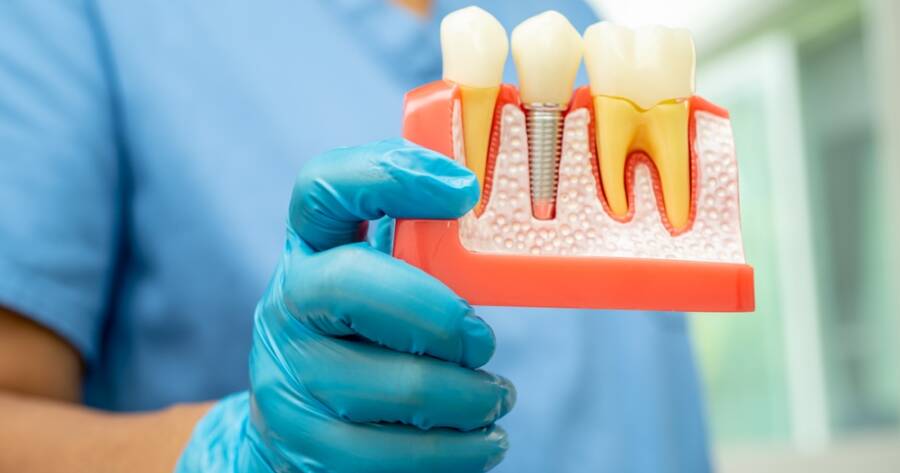 Are You a Candidate for Dental Implants?
